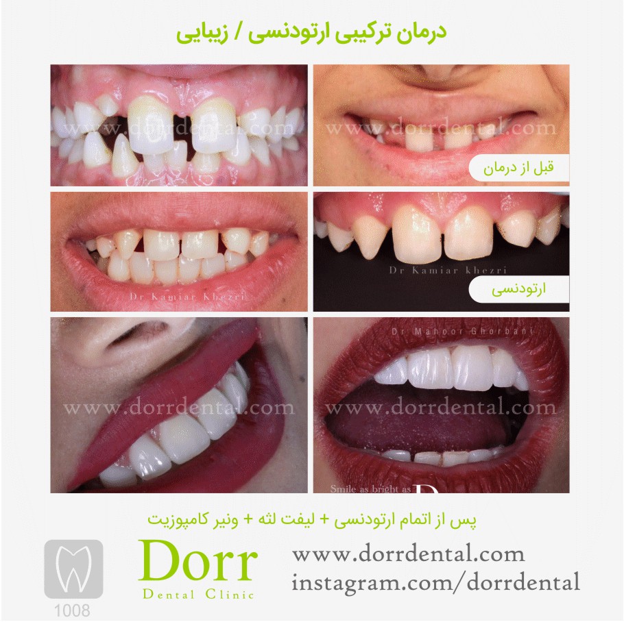 ۱۰۰۸-tooth-reconstruction-dental-restoration-before-after