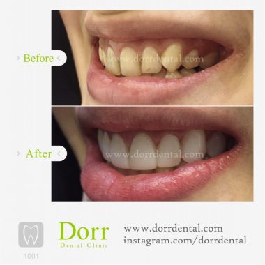 ۱۰۰۱-tooth-reconstruction-dental-restoration-before-after