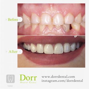 ۱۰۰۲-tooth-reconstruction-dental-restoration-before-after