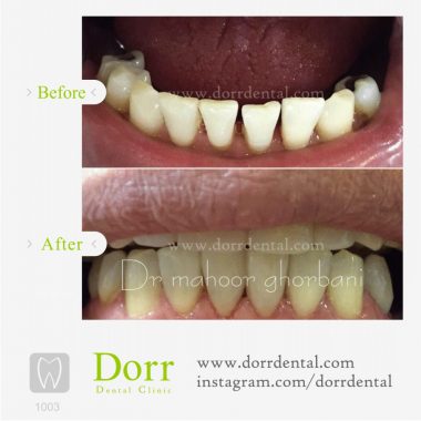 ۱۰۰۳-tooth-reconstruction-dental-restoration-before-after