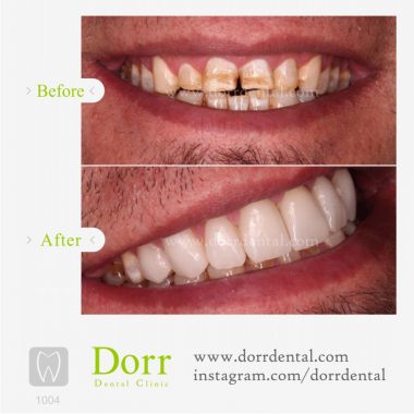 ۱۰۰۴-tooth-reconstruction-dental-restoration-before-after