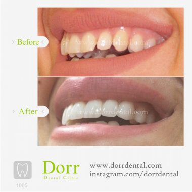 ۱۰۰۵-tooth-reconstruction-dental-restoration-before-after