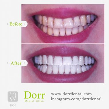 ۱۰۰۶-tooth-reconstruction-dental-restoration-before-after