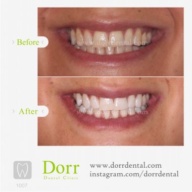 ۱۰۰۷-tooth-reconstruction-dental-restoration-before-after