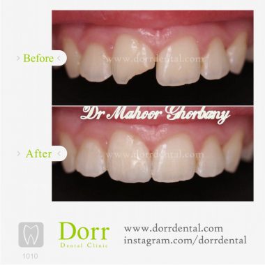 ۱۰۱۰-tooth-reconstruction-dental-restoration-before-after