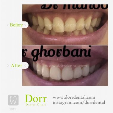 ۱۰۱۱-tooth-reconstruction-dental-restoration-before-after