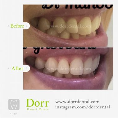 ۱۰۱۲-tooth-reconstruction-dental-restoration-before-after