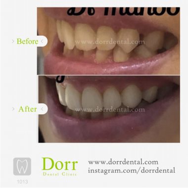 ۱۰۱۳-tooth-reconstruction-dental-restoration-before-after