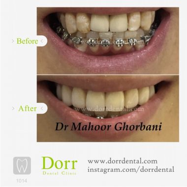 ۱۰۱۴-tooth-reconstruction-dental-restoration-before-after