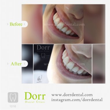 ۱۰۱۶-tooth-reconstruction-dental-restoration-before-after