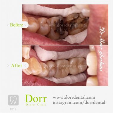 ۱۰۱۷-tooth-reconstruction-dental-restoration-before-after