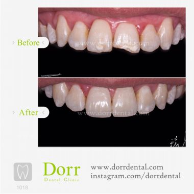 ۱۰۱۸-tooth-reconstruction-dental-restoration-before-after