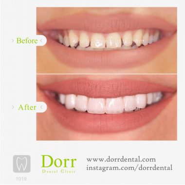 ۱۰۱۹-tooth-reconstruction-dental-restoration-before-after