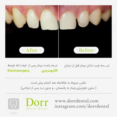 ۱۰۲۰-tooth-reconstruction-dental-restoration-before-after
