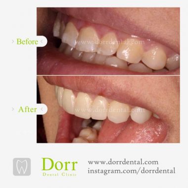 تصویر ترمیم و زیبایی دندان