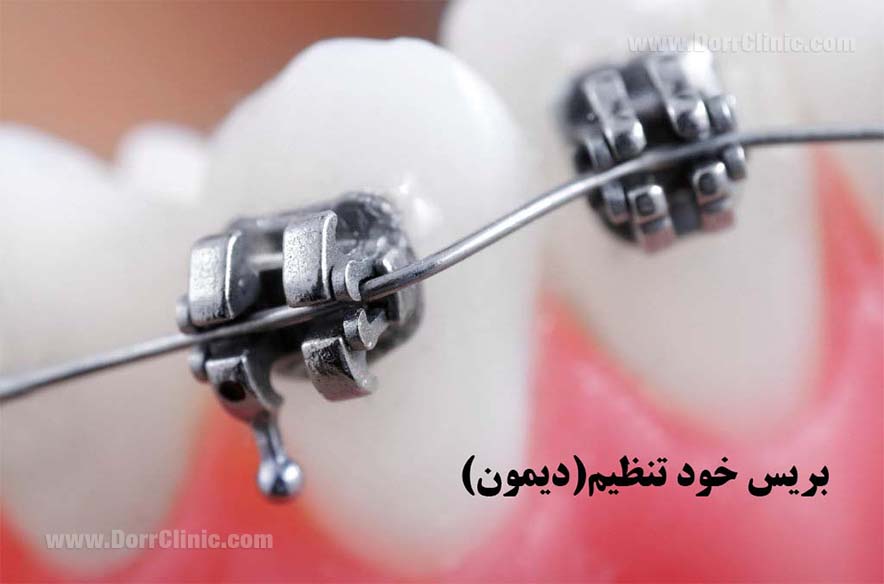 بریس های دیمون