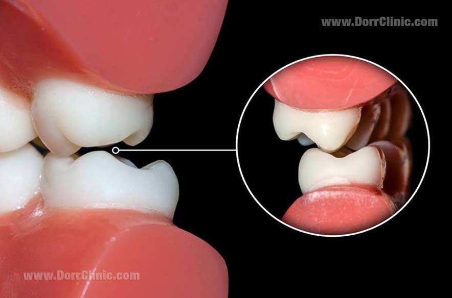 اتریشن( اصطکاک با دیگر دندان ها)
