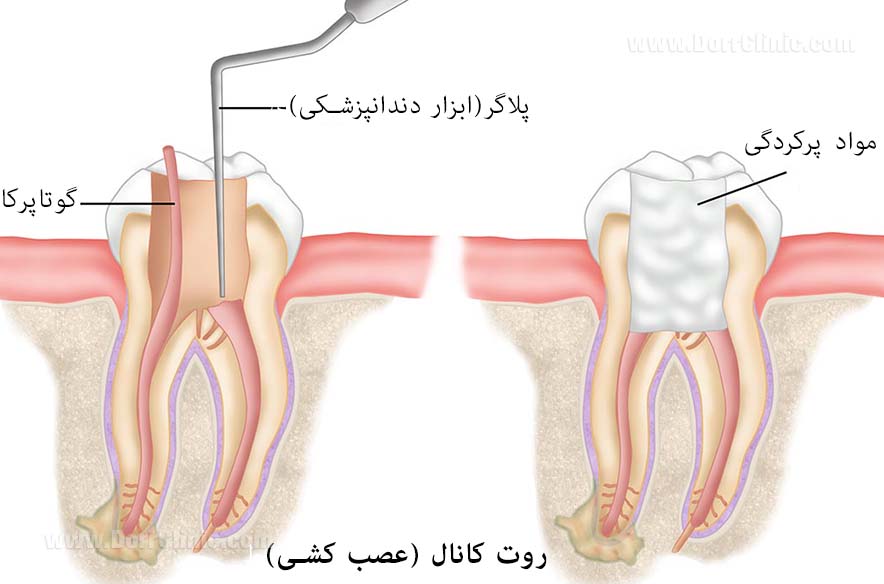 عصب کشی