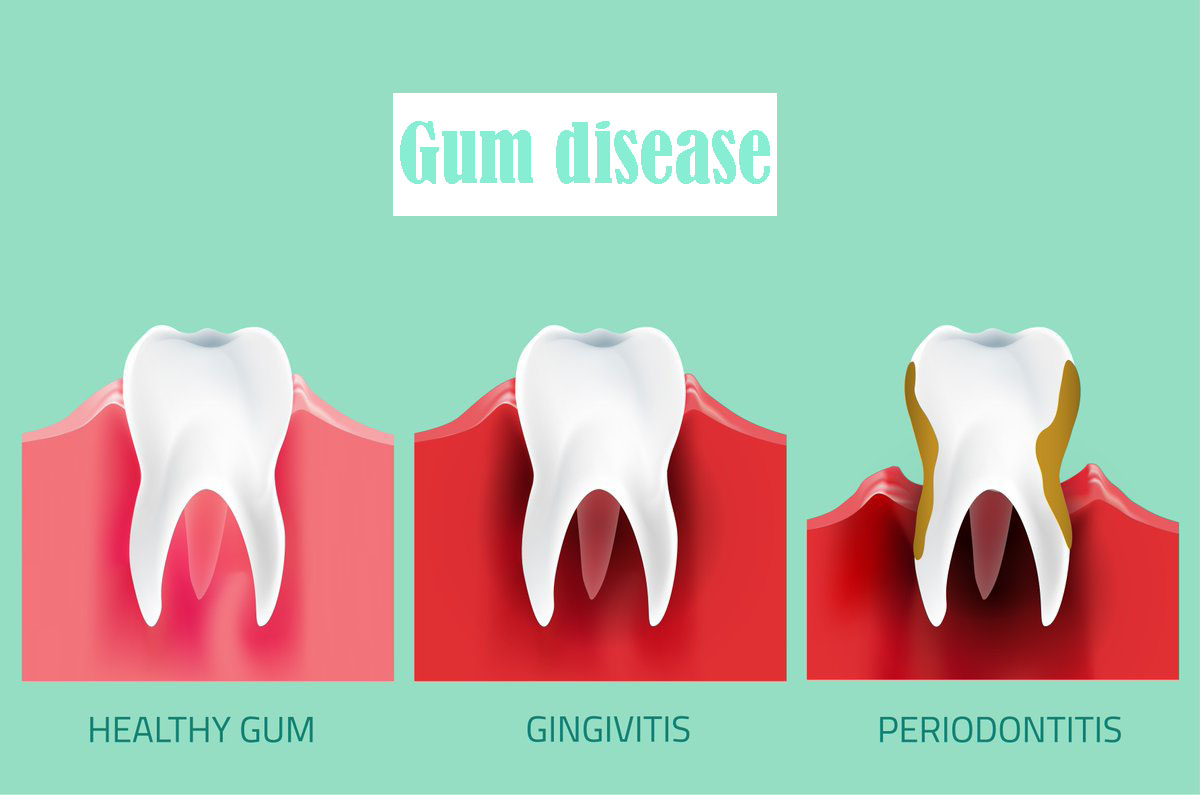 Periodontitis 