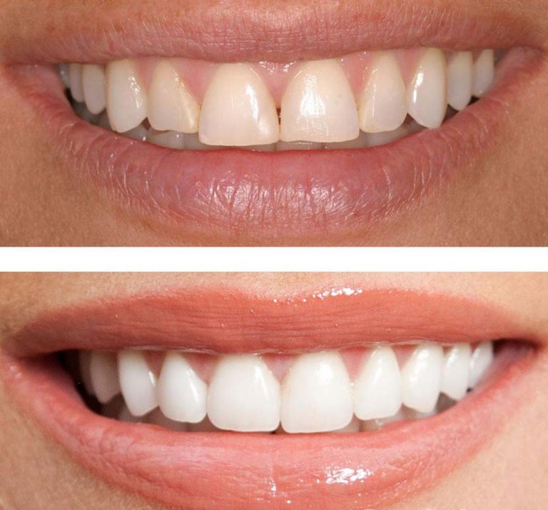 dental veneers