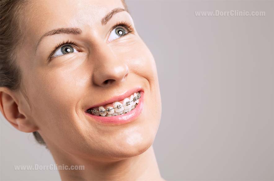 Damon Braces Damon Braces