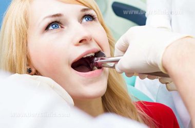 tooth extraction