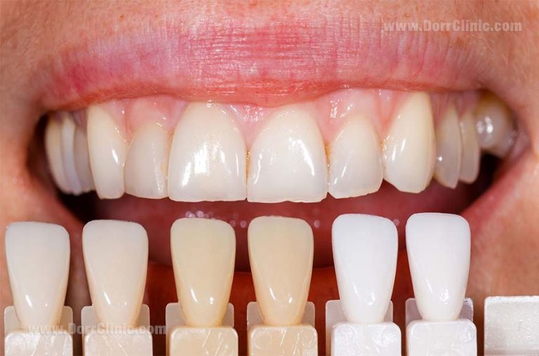 dental veneers