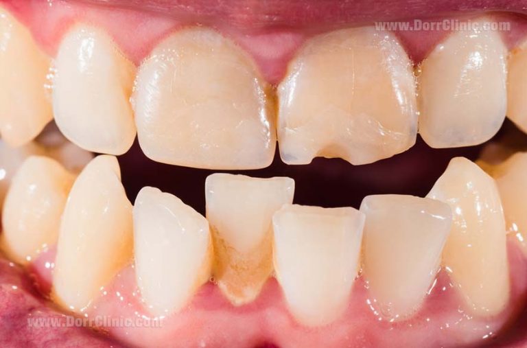 Misaligned teeth