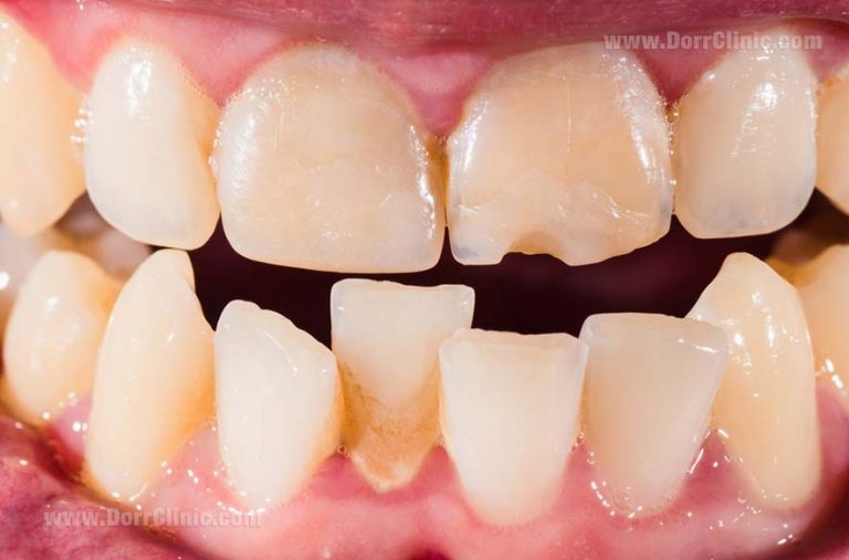 Misaligned teeth