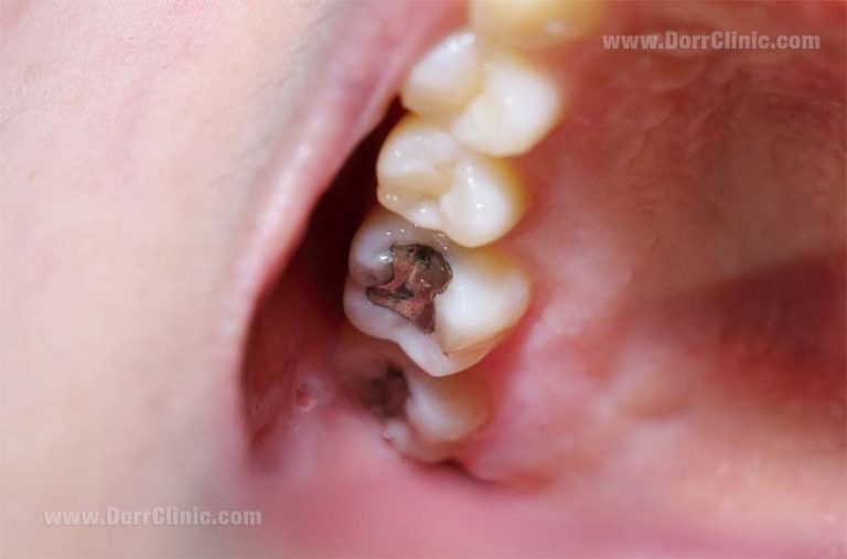 Tooth decay