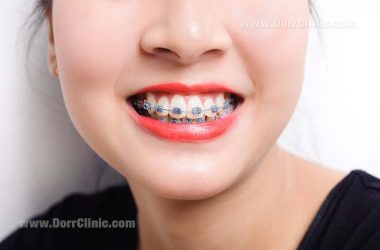 type of braces