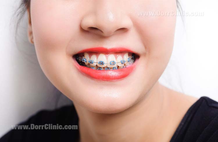 type of braces