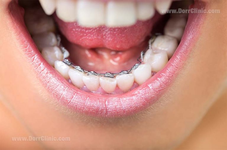 Types of Braces (Fixed Appliances)