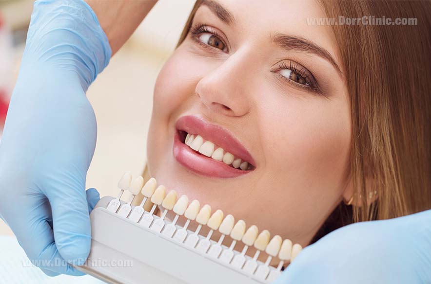 Dental laminate