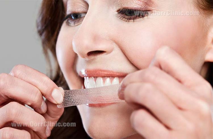 At home tooth bleaching