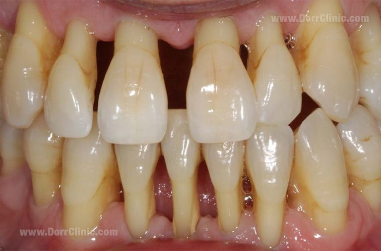 Periodontitis 