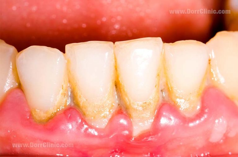 Periodontitis 