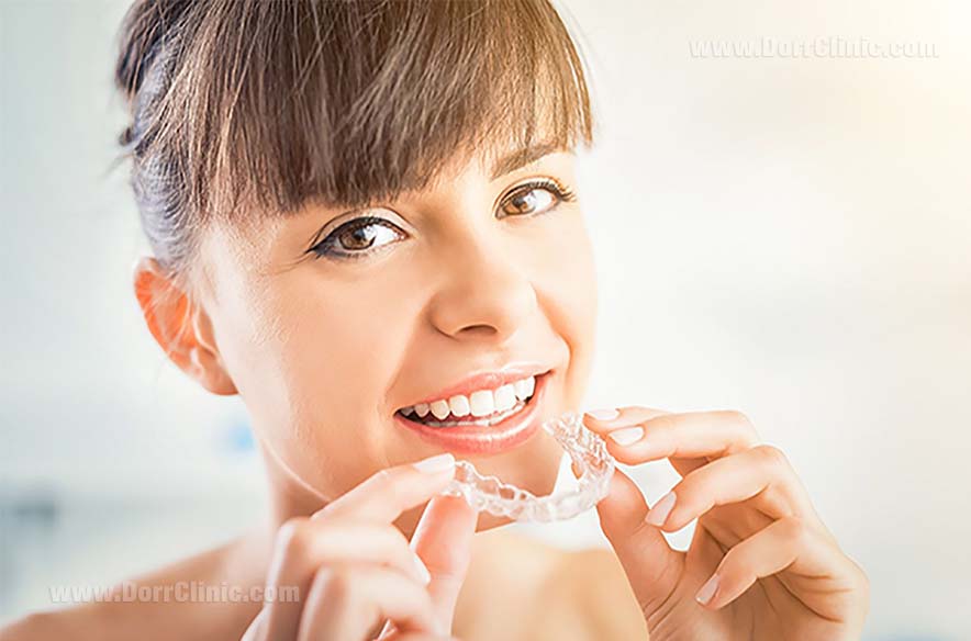 Invisalign brace