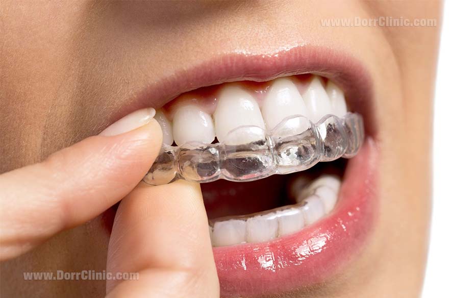 Invisalign brace