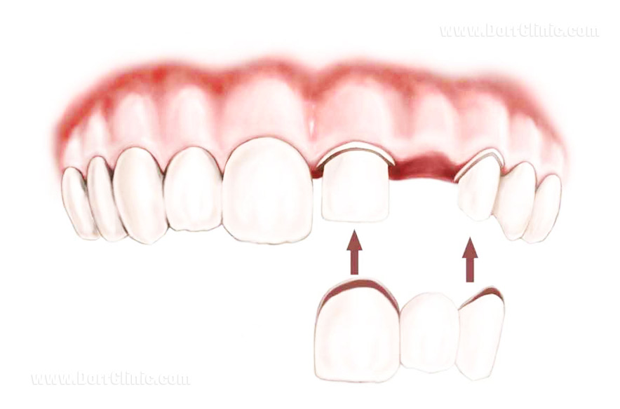 بریج برای پر کردن جای خالی دندان
