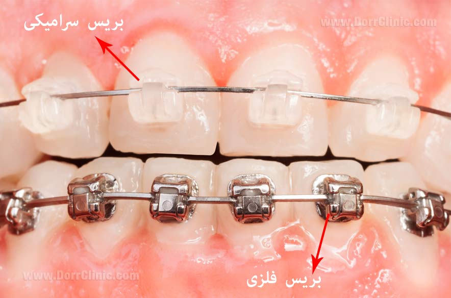 بریس سرامیکی در مقایسه با بریس فلزی