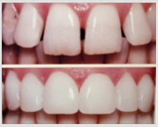 composite bonding composite bonding