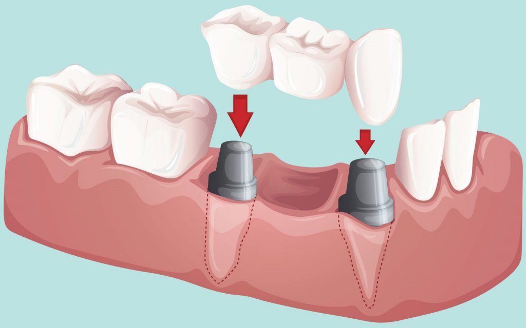 dental bridge - Dr. Ghorbani Aesthetic & Restorative specialist