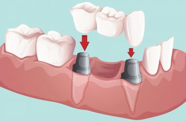 dental bridge