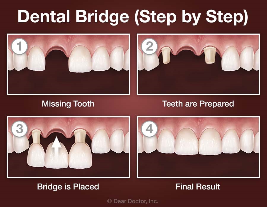 Dental bridge placement