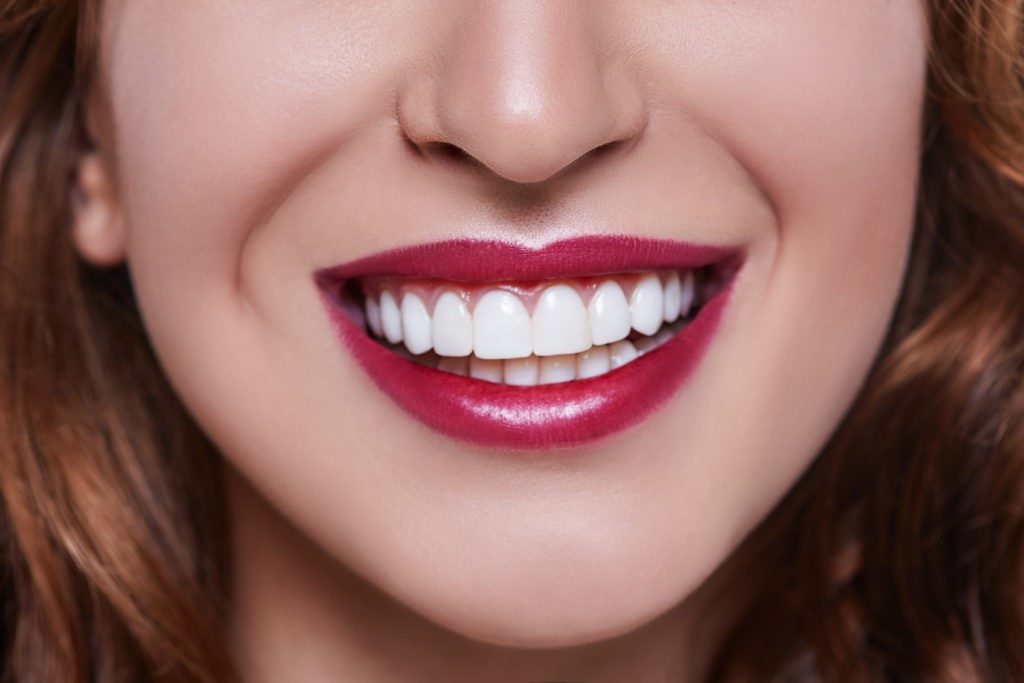 dental veneer dental veneer
