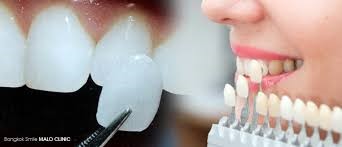 dental veneer procedure
