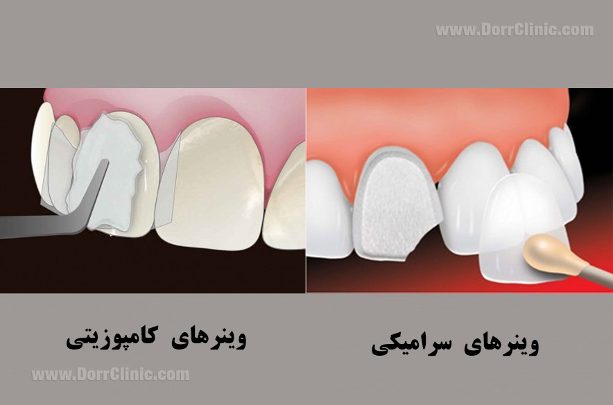 ونیر سرامیکی در مقایسه با ونیر کامپوزیت