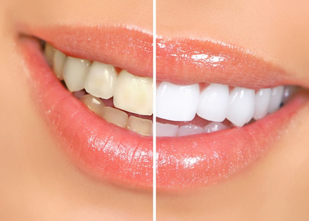 tooth whitening tooth whitening