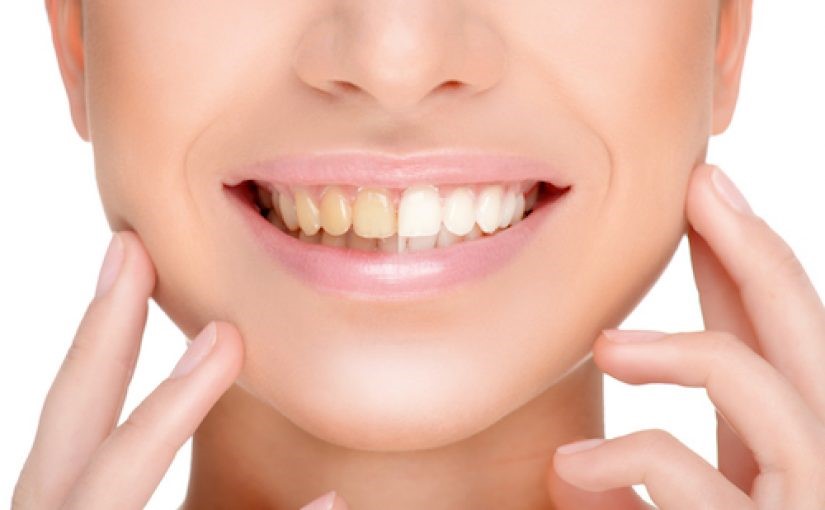 veneers whitening veneers whitening